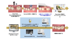 インプラント治療の流れ