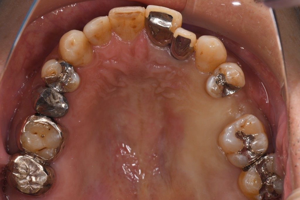 上顎奥歯へのインプラント治療