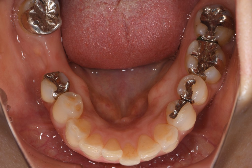 下顎奥歯へのインプラント治療