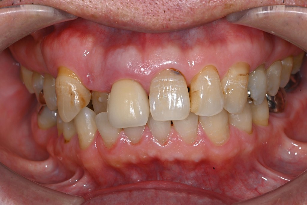 前歯右上1番のインプラント治療