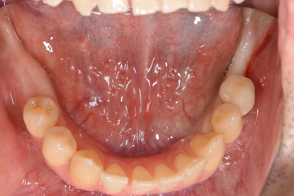 下顎奥歯へのインプラント治療(多数歯)