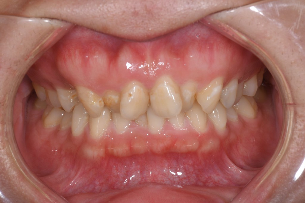 ガタガタ歯並び（叢生）のインビザライン矯正