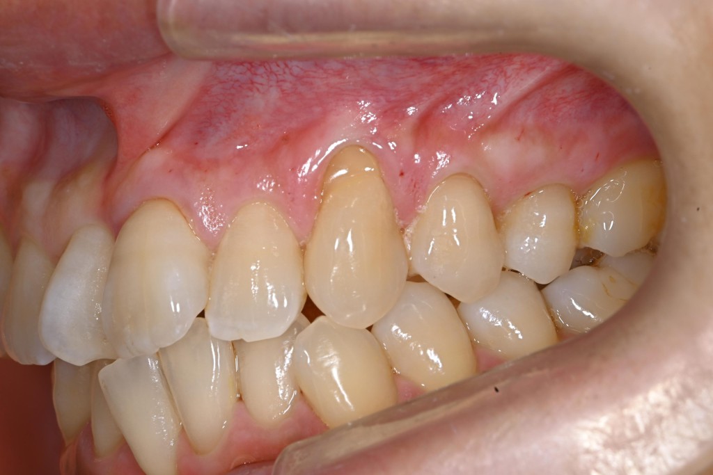 上顎歯肉退縮治療（１歯）の症例