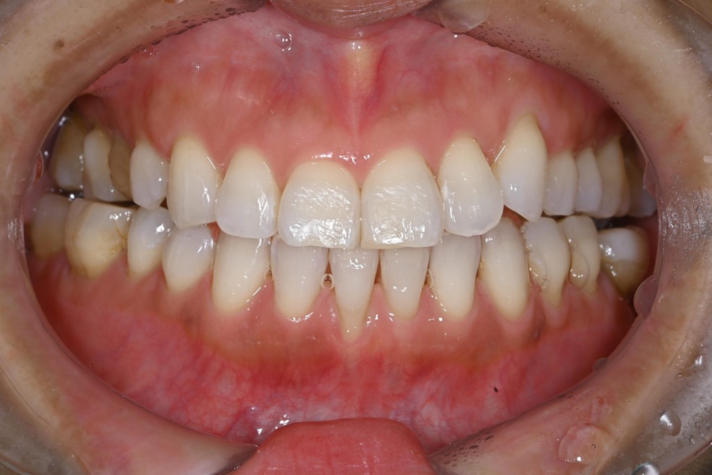 下顎歯肉退縮治療（１歯）の症例