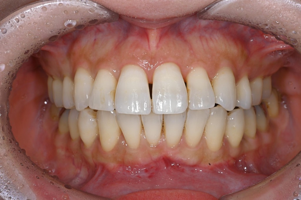 上下顎歯肉退縮治療（多数歯）の症例