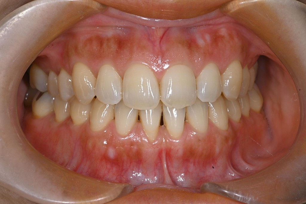 下顎歯肉退縮治療（多数歯）の症例