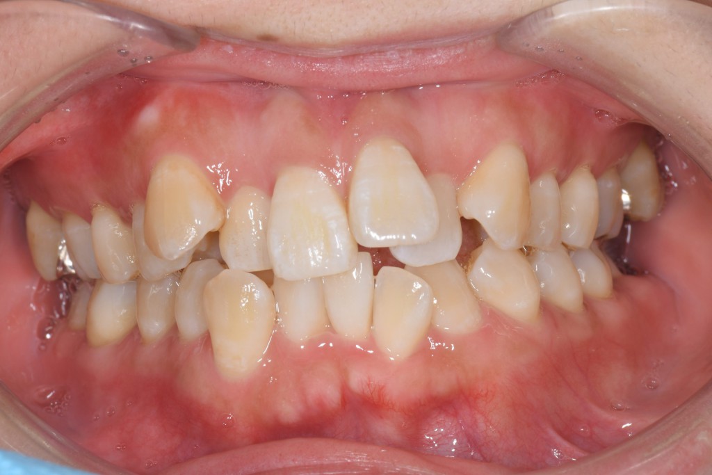 重度のガタガタ歯並び（叢生）のインビザライン矯正