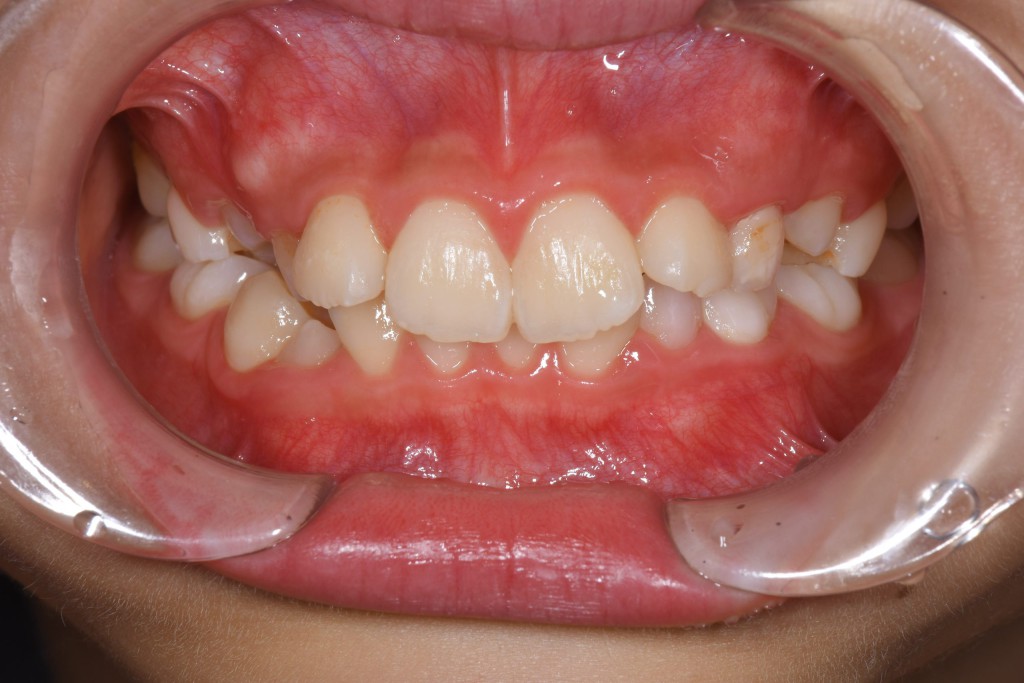 重度のガタガタ歯並び（叢生）のインビザライン矯正