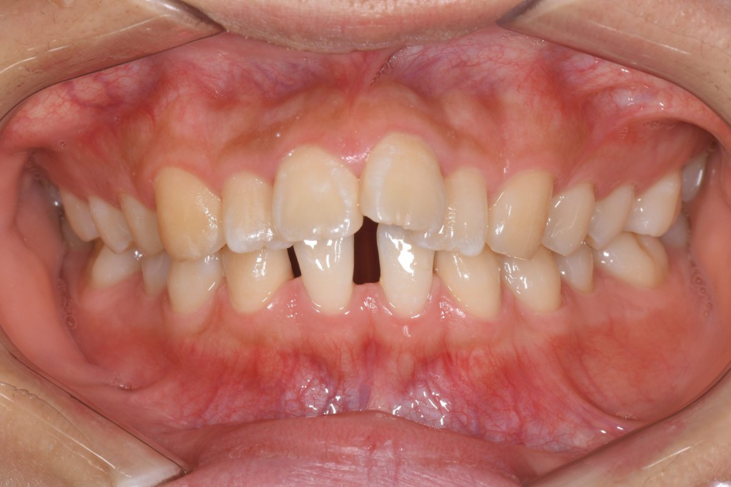 前歯の欠損歯列のインビザライン矯正