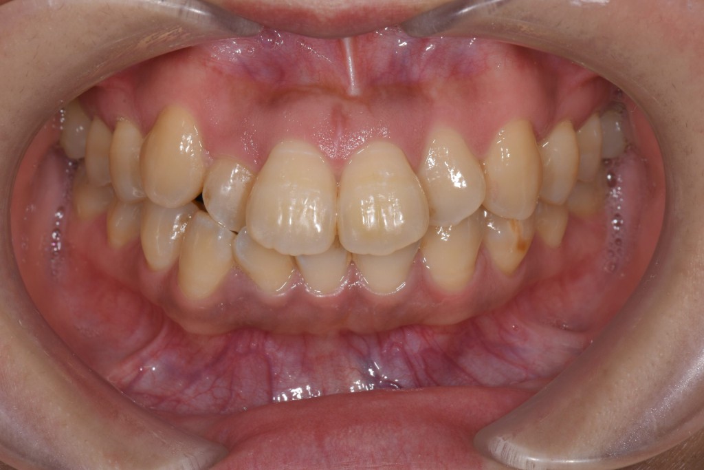 欠損のガタガタ歯並び（叢生）のインビザライン矯正