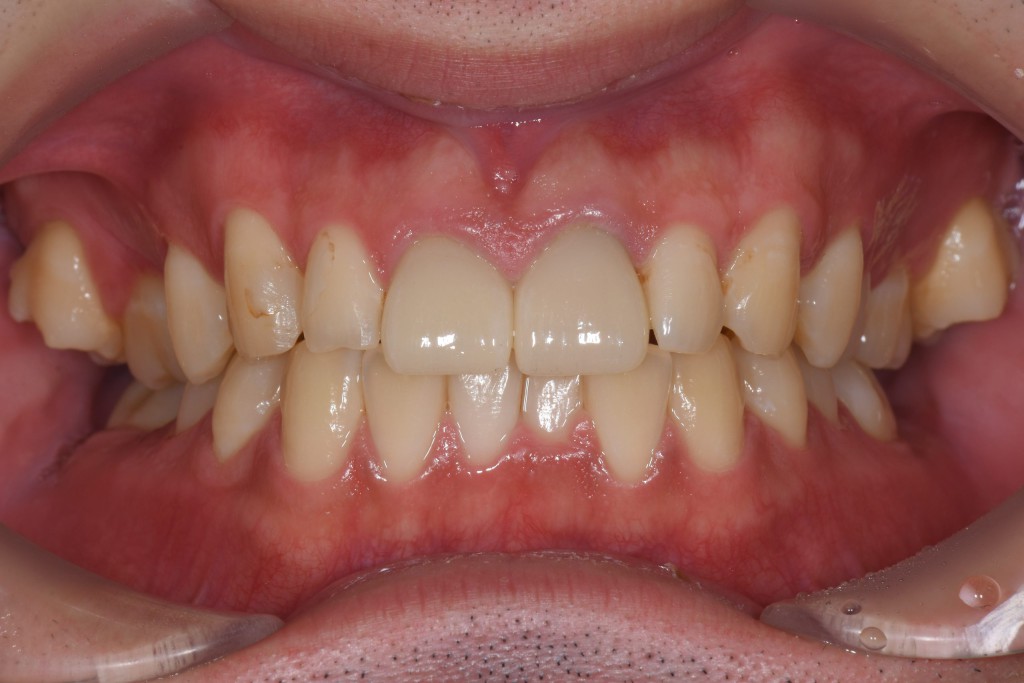 奥歯のガタガタ歯並び（叢生）のインビザライン矯正