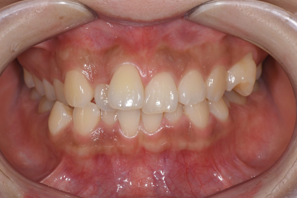 重度のガタガタ歯並び（叢生）のインビザライン矯正