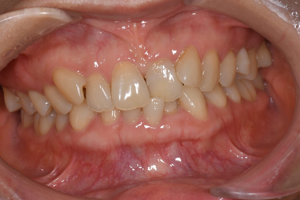 ガタガタ歯並び（叢生）のインビザライン矯正