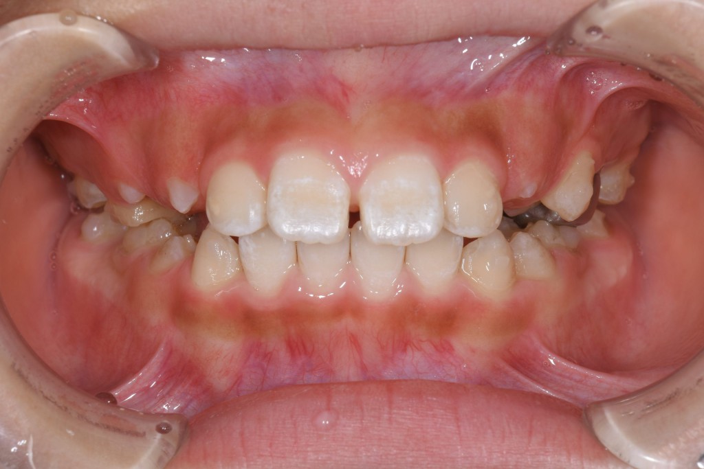 子供のすきっ歯のインビザライン矯正