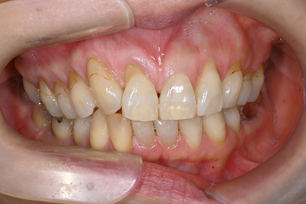 上顎歯肉退縮治療（多数歯）の症例
