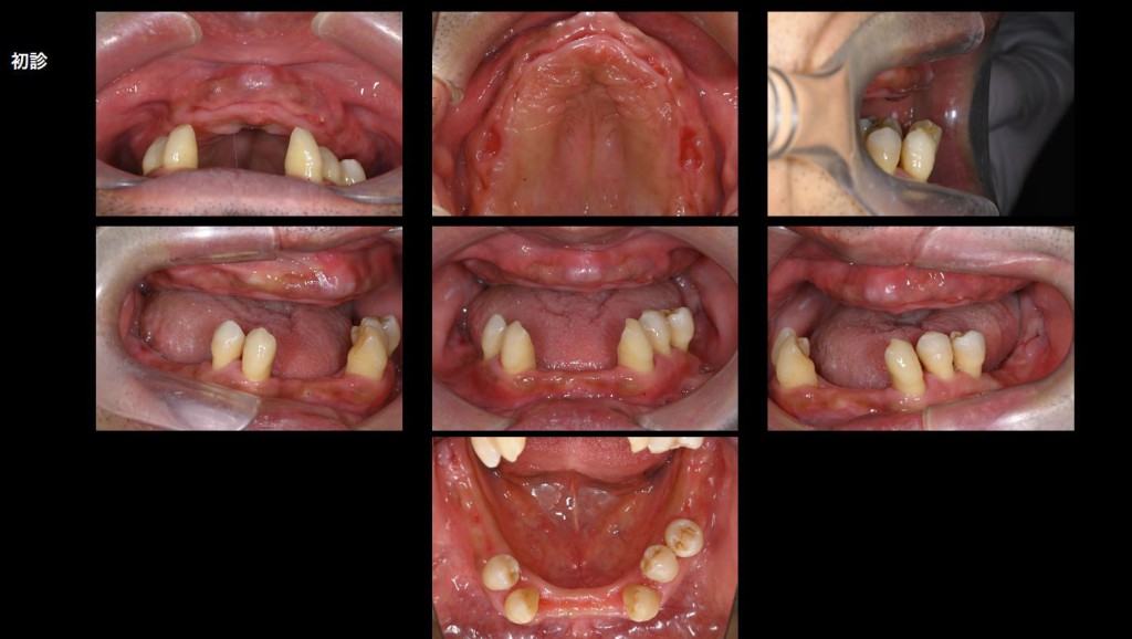 下顎へのインプラント症例(デジタル複合)