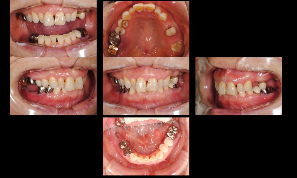 奥歯のインプラント治療