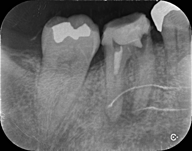 下顎奥歯の根管治療