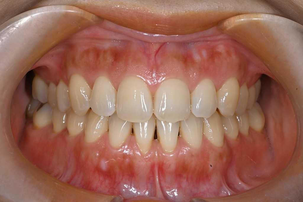 下顎歯肉退縮治療の症例
