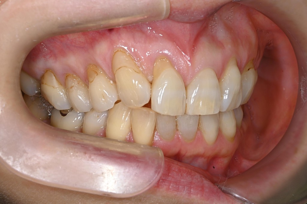 上顎歯肉退縮治療の症例