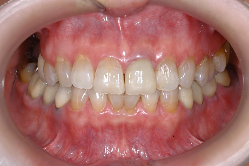 前歯のインプラントの症例