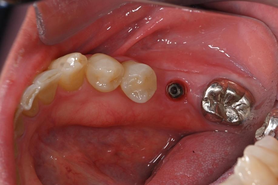 奥歯のインプラントの症例