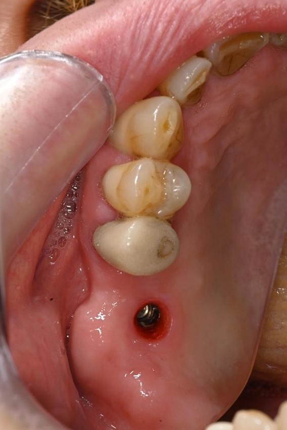 奥歯のインプラントの症例