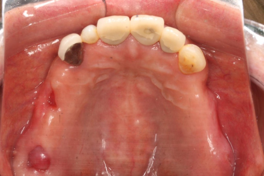 奥歯のインプラントの症例
