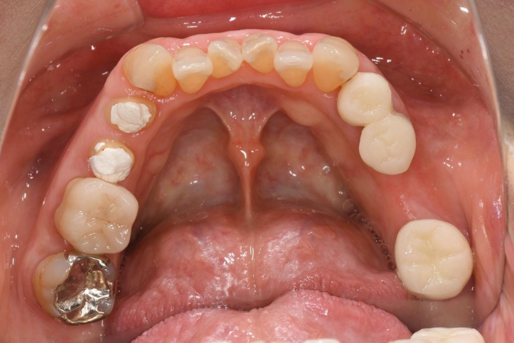 奥歯のインプラントの症例