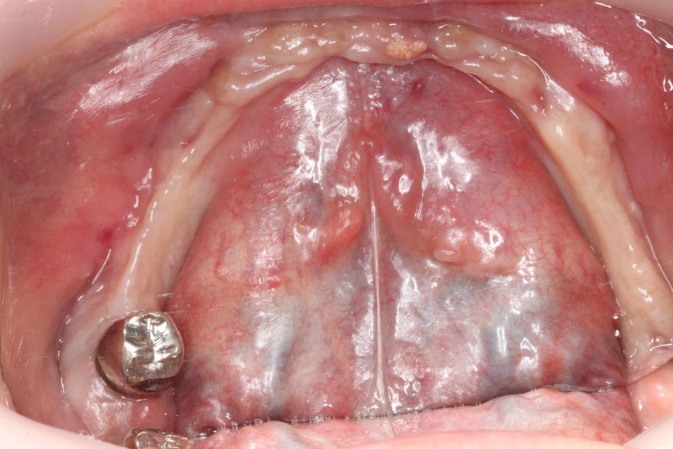 下顎のインプラントの症例