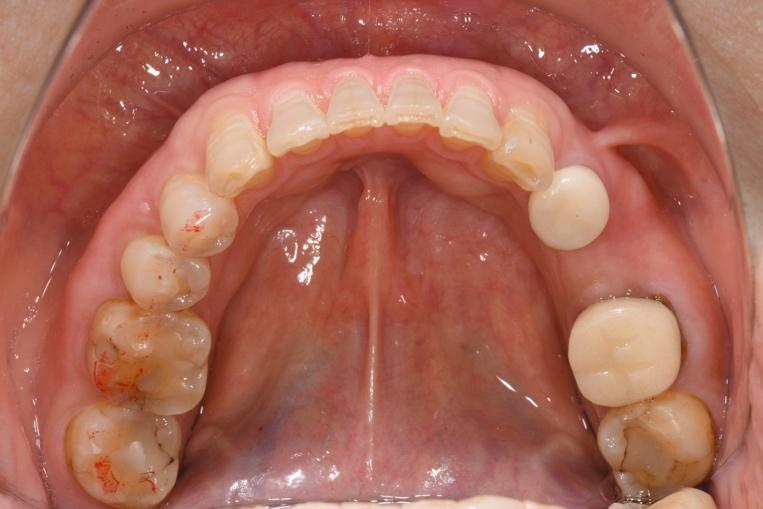 奥歯のインプラントの症例