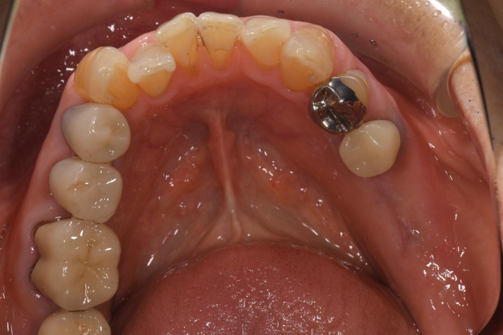 奥歯のインプラントの症例
