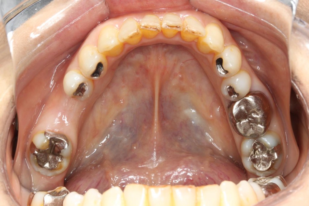 奥歯のインプラントの症例