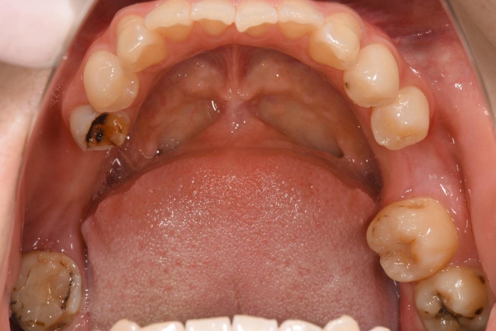 奥歯のインプラントの症例