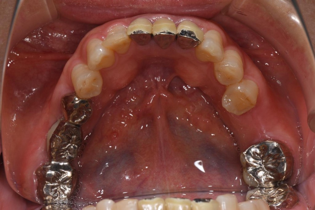 奥歯のインプラントの症例