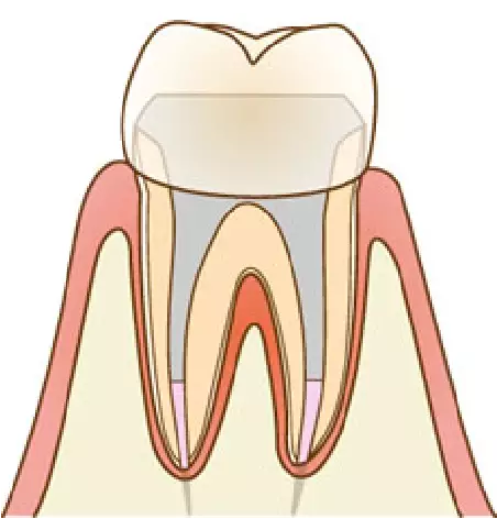 被せ物の治療