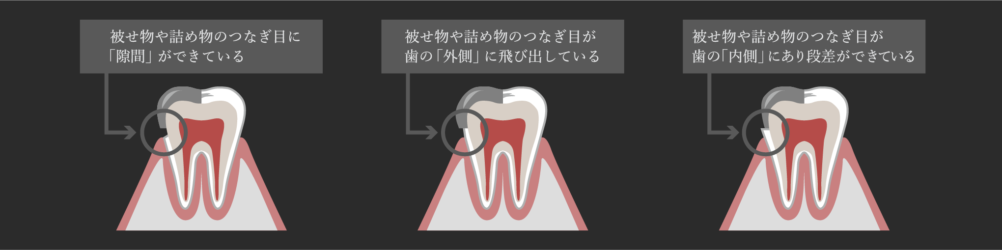 治療後の被せ物の適合精度の重要性