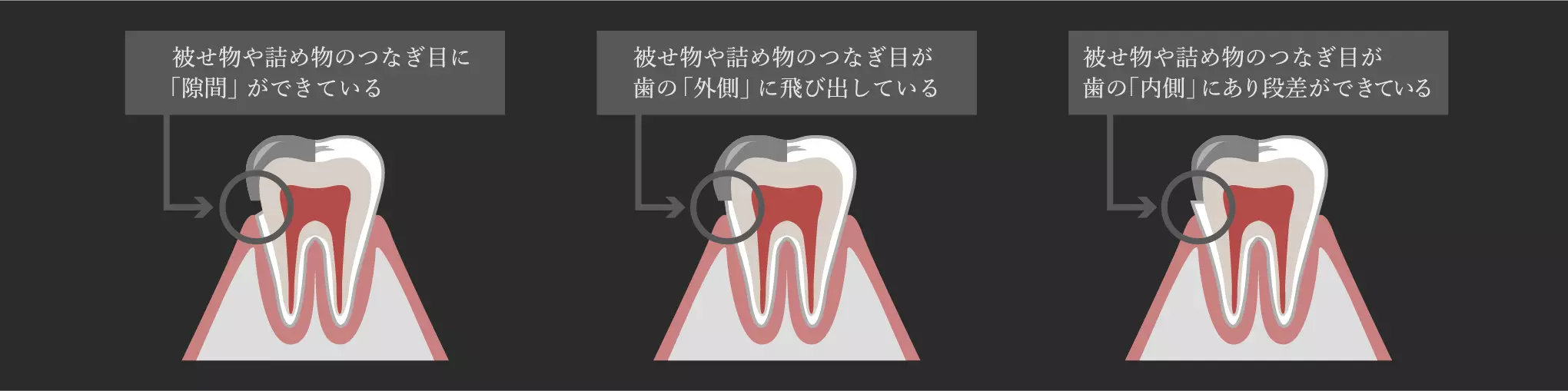 治療後の被せ物の適合精度の重要性