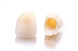 仮歯