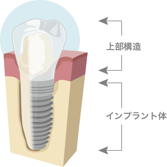 インプラント10年保証について