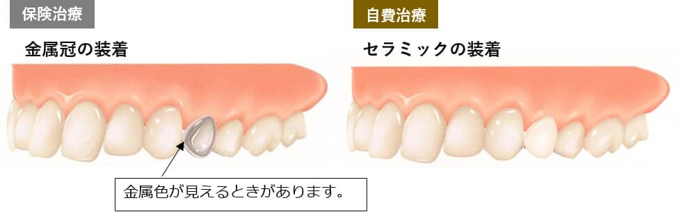 保険治療と自費治療の違い