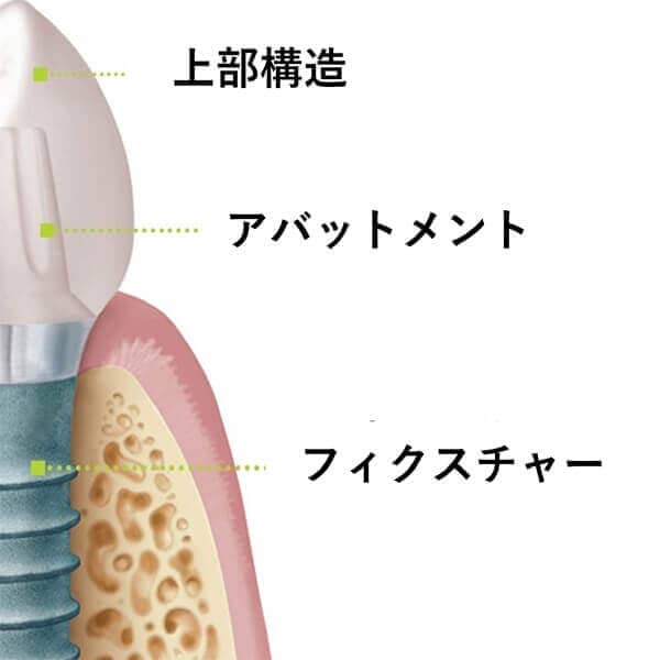 インプラントの構造