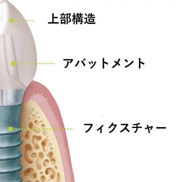 インプラントの構造