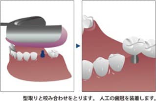 人工歯冠の制作