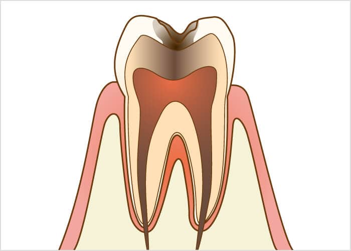 虫歯治療