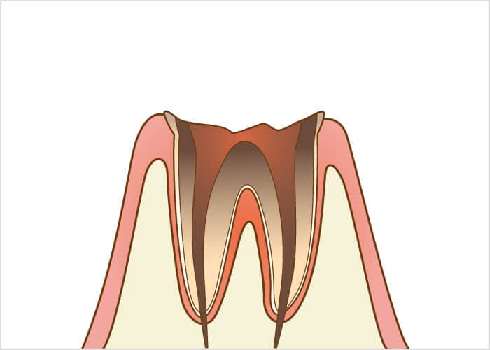 根管治療