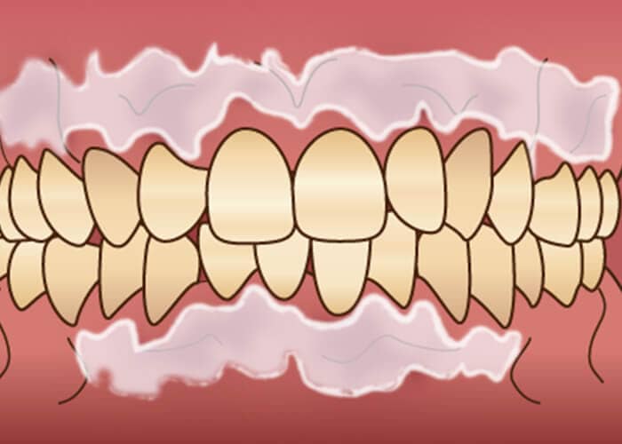 歯肉の色素沈着