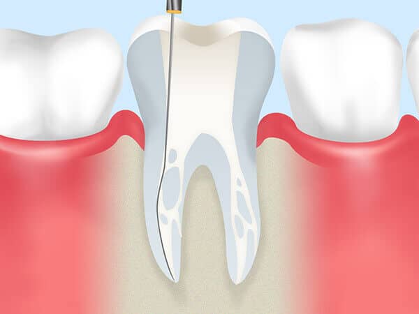 根管治療