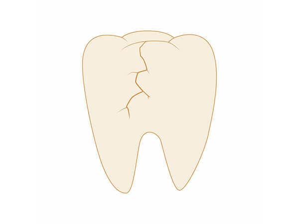 歯のクラック（亀裂）の確認