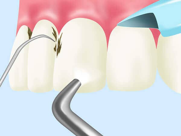 歯周病治療